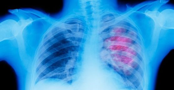 Akciğer kanseri olan hastaların ilaç parası için 'sigara içmemiş' olma şartı!