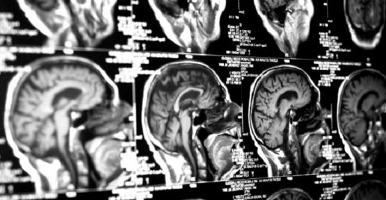 Beyin rahatsızlıkları için telefon kontrollü implant geliştirildi