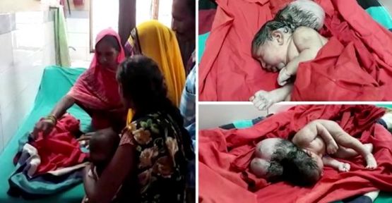 Hindistan'da üç başlı bebek doğdu