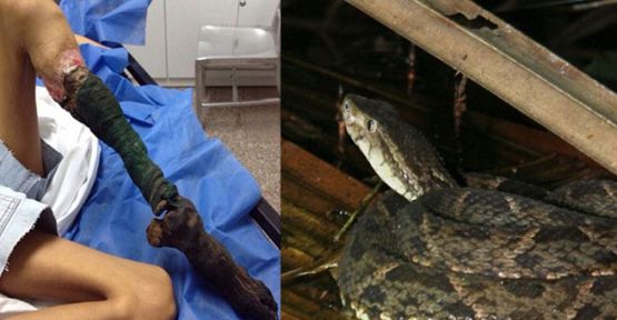 Yılan ısırığı bu hale getirdi