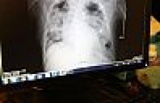 Rusya'da yeni bir korona tedavisi geliştirildi